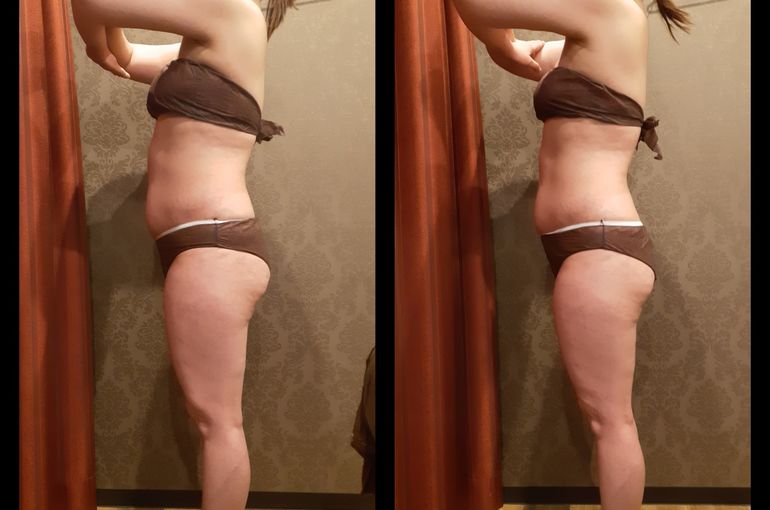 福岡市早良区野芥のエステサロンドルチェヴィータ★ウルトランスフォーマー痩身モニター様ビフォーアフター