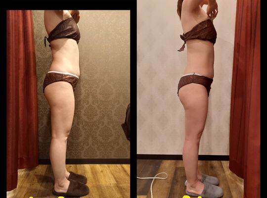 福岡市早良区野芥のエステサロンドルチェヴィータ★痩身ダイエットモニター様ビフォーアフター