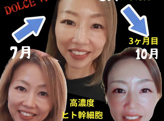 福岡市早良区野芥のエステサロンドルチェヴィータ★高濃度ヒト幹細胞培養液