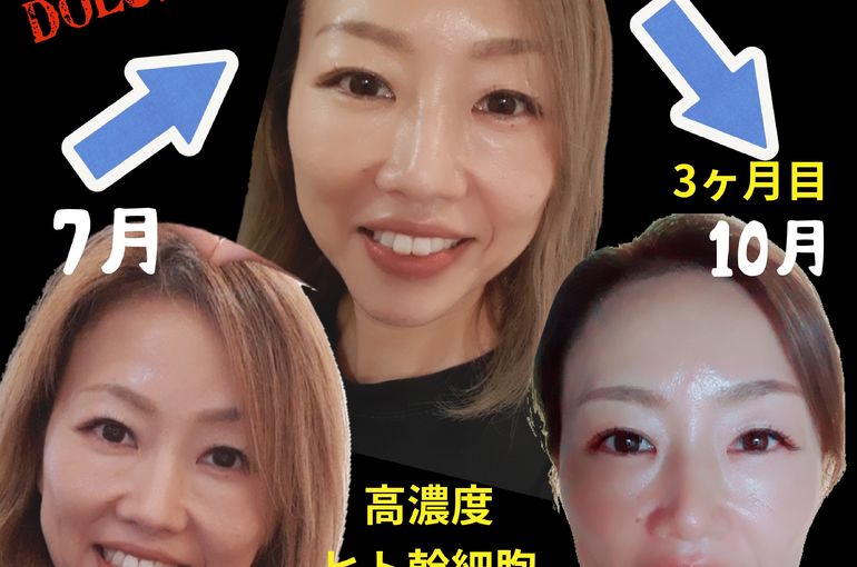 福岡市早良区野芥のエステサロンドルチェヴィータ★高濃度ヒト幹細胞培養液