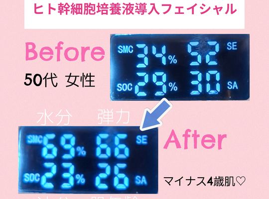 福岡市早良区【エステ】ドルチェヴィータ★ヒト幹細胞培養液導入フェイシャル