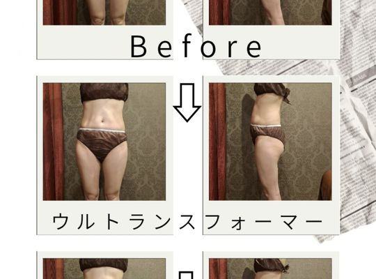 福岡市早良区【エステ】ドルチェヴィータ★【痩身モニター】2週間でここまで変化♡ Before→After公開！